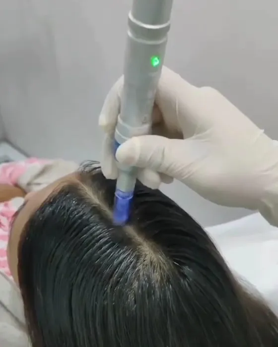 Hair PRP treatment at Smile & Glow