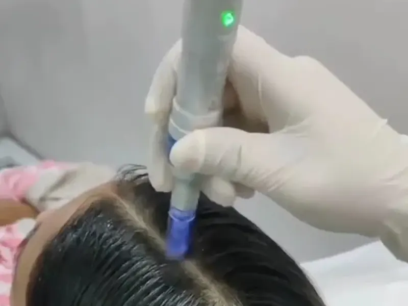 Hair PRP treatment in progress