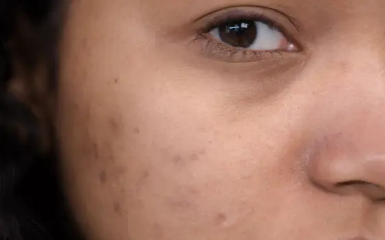 Close-up of skin with acne marks