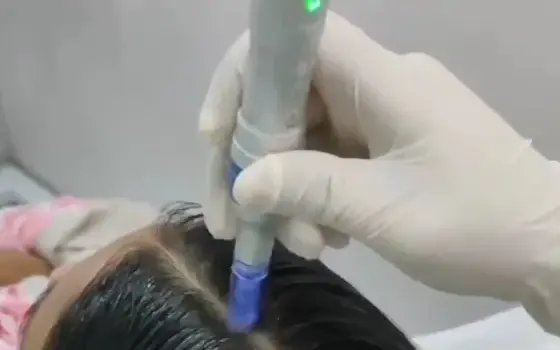 Hair PRP treatment at Smile & Glow